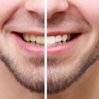 Bye Bye, Yellow Teeth! How Coconut Oil Pulling Can Transform Your Smile in Just 7 Days! Thewellthieone
