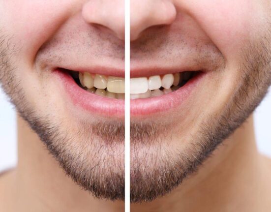 Bye Bye, Yellow Teeth! How Coconut Oil Pulling Can Transform Your Smile in Just 7 Days! Thewellthieone