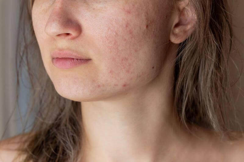 Acne symptoms can heal much faster with exfoliation and a dairy free diet.