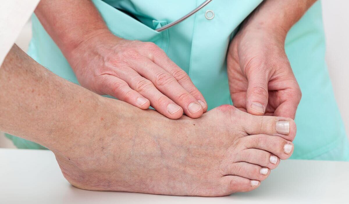 Bunion Exercises – How to Treat Bunions Naturally
