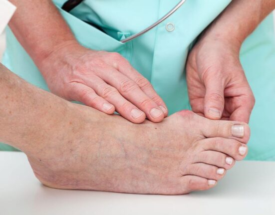 Bunion Exercises – How to Treat Bunions Naturally