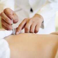 Dry Needling vs Acupucture - How Does Each Therapy Benefit You TheWellthieoen