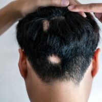 How To Stop Alopecia Areata From Spreading This Non-Invasive Solution May Surprise You! Thewellthieone
