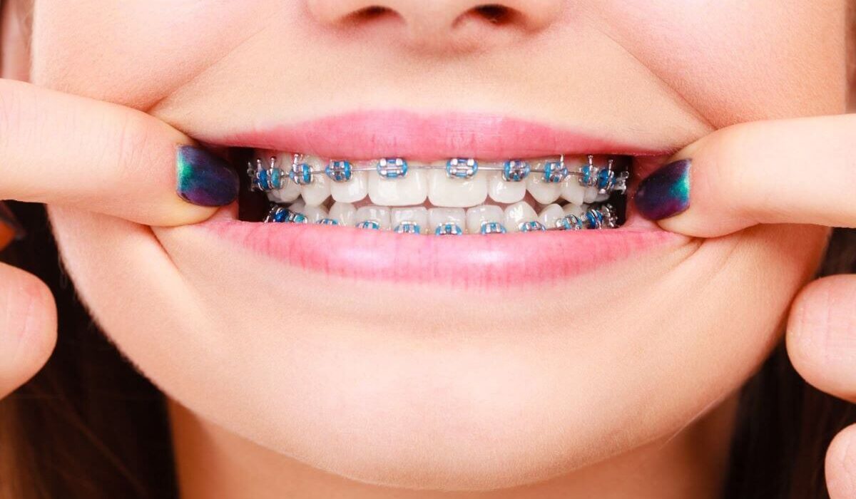 You-Asked-We-Answered-Everything-You-Need-to-Know-About-Bracket-Braces-TheWellthieone-