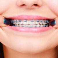 You-Asked-We-Answered-Everything-You-Need-to-Know-About-Bracket-Braces-TheWellthieone-