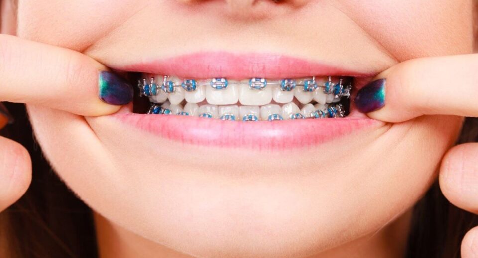 You-Asked-We-Answered-Everything-You-Need-to-Know-About-Bracket-Braces-TheWellthieone-