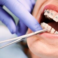 Caring for Your Teeth With Braces - 6 Things to Consider Putting in Your Braces Kit TheWellthieone