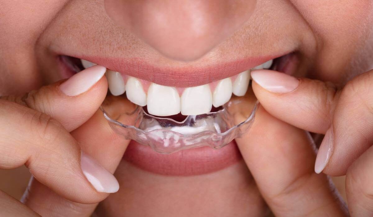 Everything You Need To Know About Removable Braces