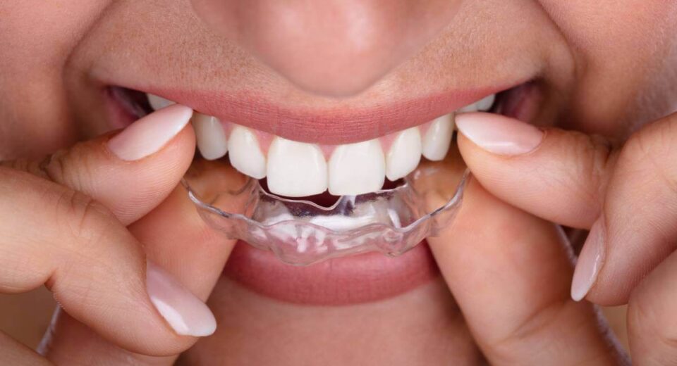 Everything You Need To Know About Removable Braces
