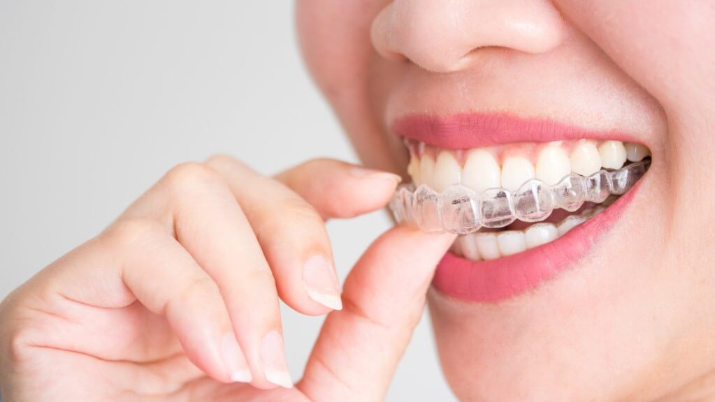 Everything You Need To Know About Removable Braces TheWellthieoen