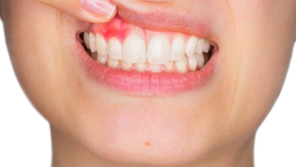Gum Abscess StagesA Dental Hygienist’s Guide to Gum Abscesses