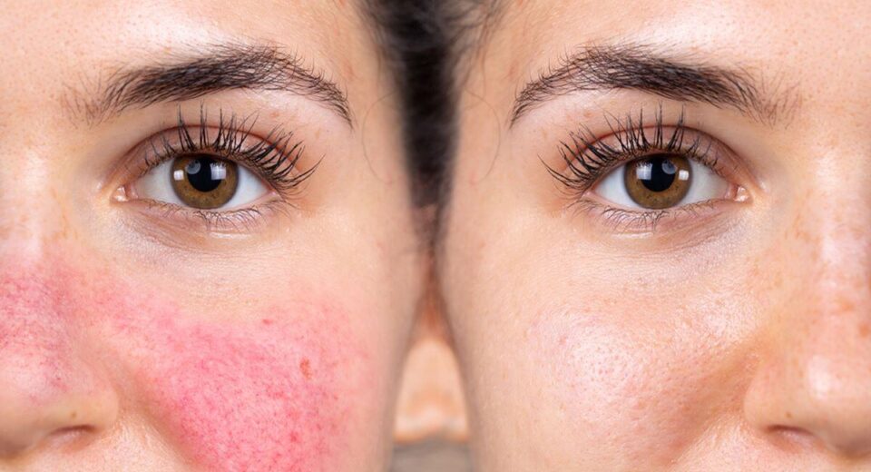 Rosacea vs Eczema - What is the Difference? 4 Natural Solutions TheWellthieone