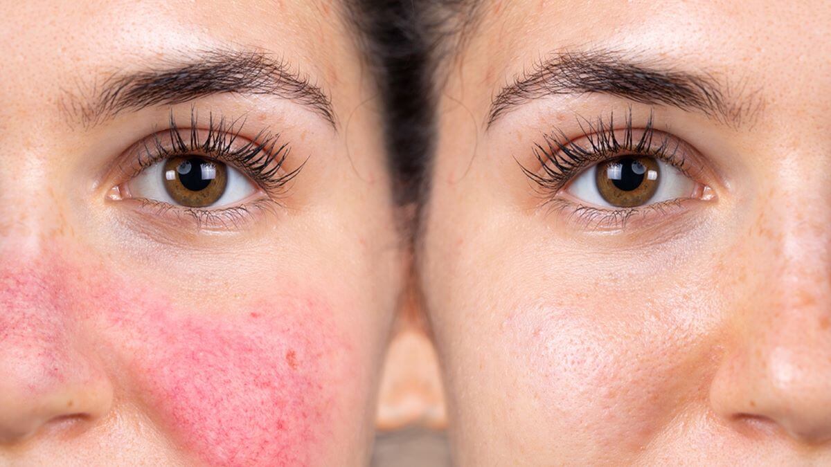 Rosacea vs Eczema - What is the Difference? 4 Natural Solutions TheWellthieone