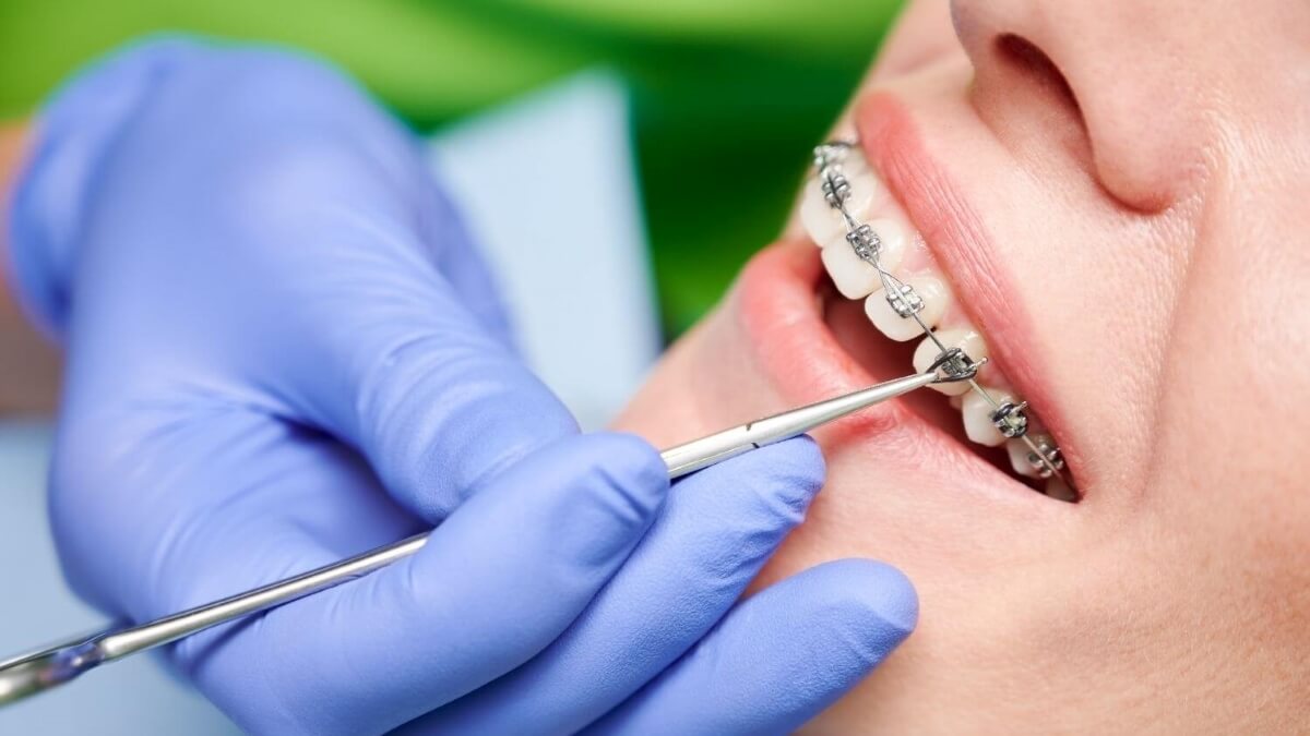 How Much Do Braces Hurt On A Scale From 110? TheWellthieone