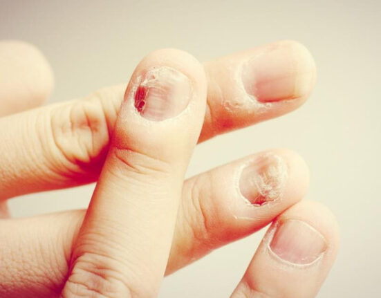 Nail Psoriasis vs. Fungus What's the Difference TheWellthieoene
