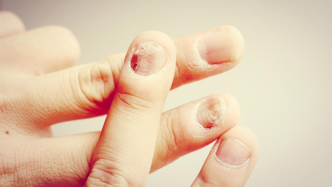 Nail Psoriasis vs. Fungus What's the Difference TheWellthieoene