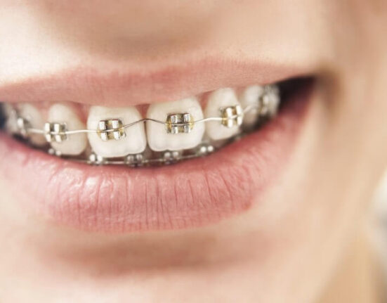 You Asked, We Answered Everything You Need to Know About Bracket Braces TheWellthieone (1)