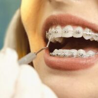 How Much Do Braces Hurt On A Scale From 1-10 TheWellthieone