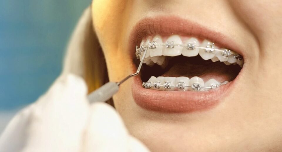 How Much Do Braces Hurt On A Scale From 1-10 TheWellthieone