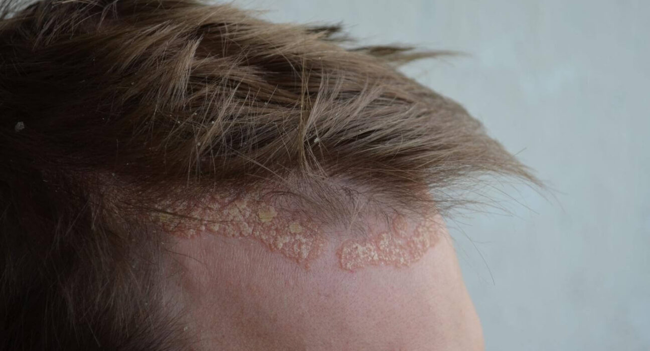 How to Use Manuka Honey For Scalp Psoriasis TheWellthieone