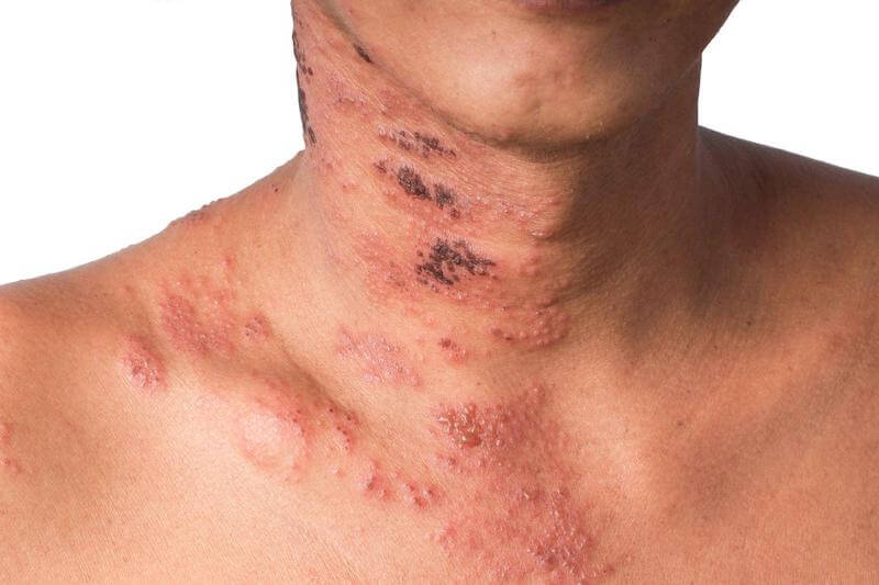 Shingles scars during the different stages of shingles.  Scars at the base of the neck, pustules above the collar bone, and scabs on the neck.
