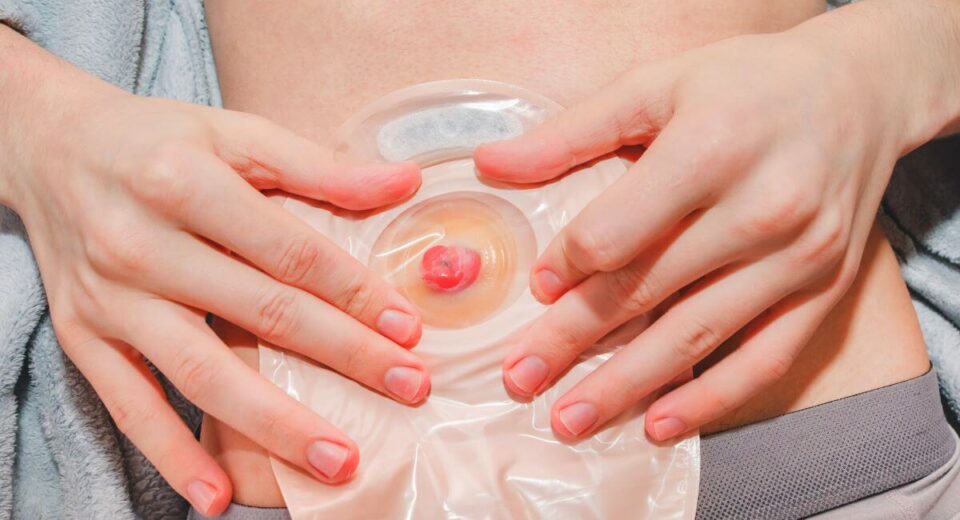 9 Causes of A Prolapsed Stoma and How to Fix It TheWellthieone