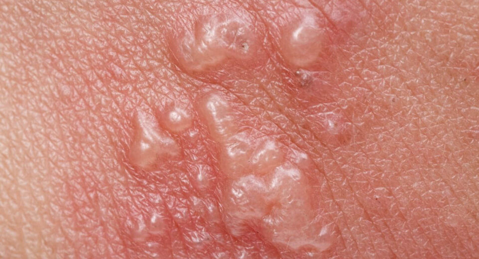 Does Shingles Leave Scars? Your Questions Answered TheWellthieone