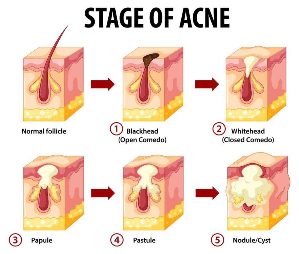 The pores in the skin offer the body a way to remove toxins.  When a vaper is ingesting numerous toxic chemicals through vaping, the body tries to rid itself of these toxins indifferent ways, one way is by way of the skin.  Acne means the body is trying to cleanse itself.
