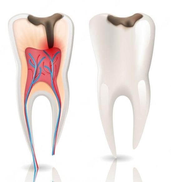Root canals are necessary when the decay has reached the pulp inside the tooth causing a lot of pain. Cracked fillings can lead to a root canal as they let bacteria inside the once protected area that was decayed.
