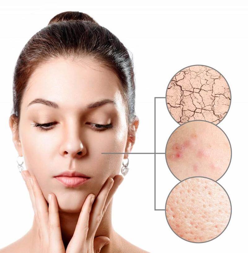 Microneedling is an effective way to reduce wrinkles, larger pores and blemishes.  It causes the area that has been microneedled to increase production of collagen, which will bring vibrancy and plump up that area so you can see visible results in the short term.
