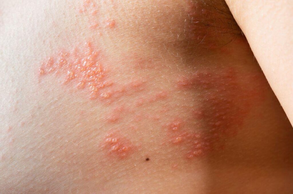 Shingles are a painful rash with some bumps filled with liquid that form on one side of the body.  These clusters of rashes can cause scarring, and steps can be taken to minimize scars.
