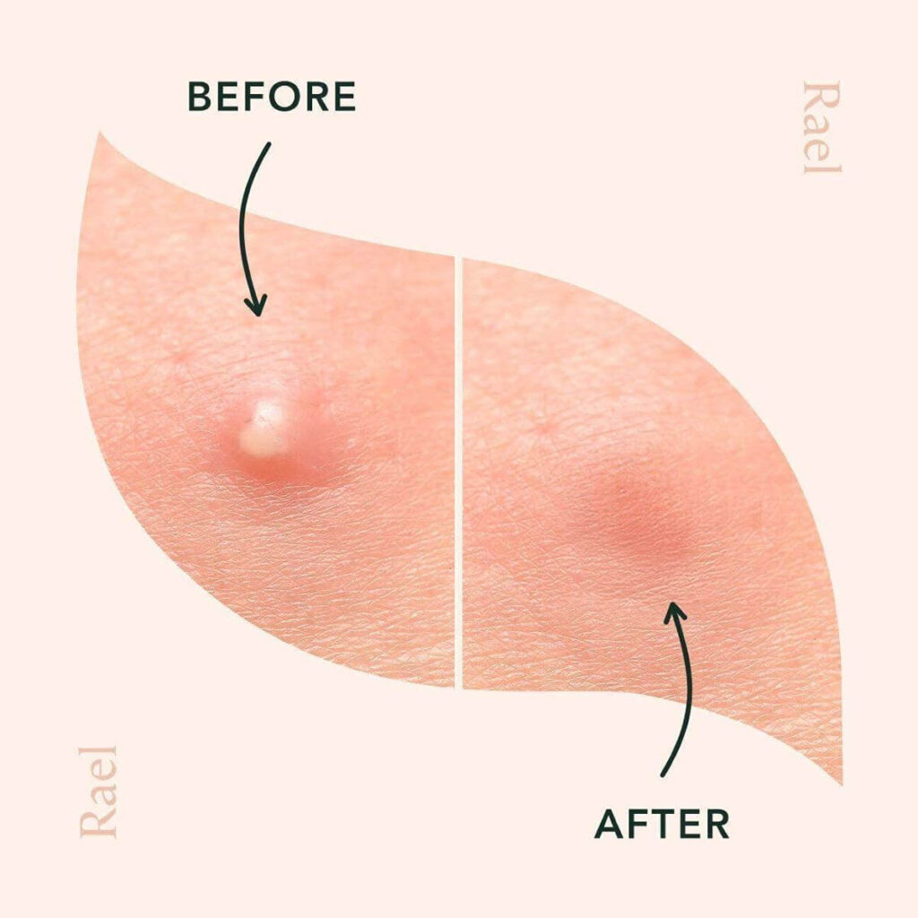 The pimple is almost undetectable after applying the patch.

