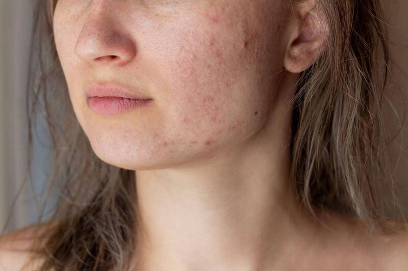 Whiteheads from cystic acne was visibly reduced within 1.5 weeks of using turmeric soap.  Redness started to fade after 2 weeks of use.
