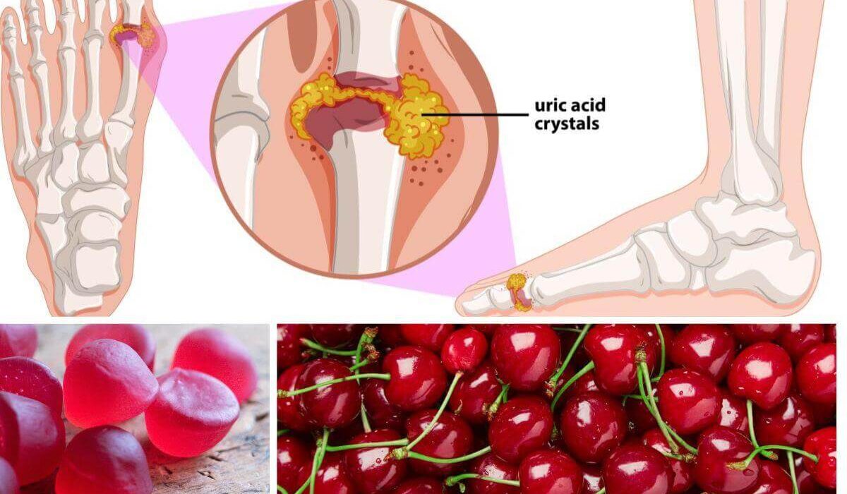 Get the Gout Out With Cherry Gummies! TheWellthieone