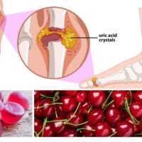Get the Gout Out With Cherry Gummies - Here’s the 2 Best Choices! TheWellthieone