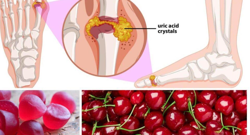 Get the Gout Out With Cherry Gummies - Here’s the 2 Best Choices! TheWellthieone