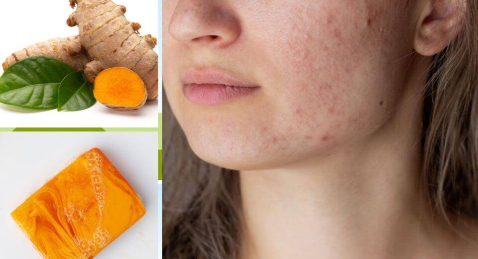 Tumeric Soap For Acne Reviews Are In! Does It Really Work? TheWellthieone