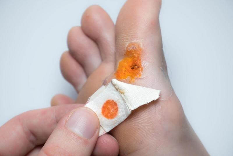 Apply iodine a 2-3 times a day and cover with a bandaid.  Over time, the plantar wart should diminish.