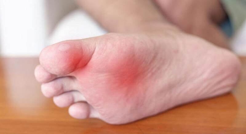 A sprained toe will appear to be swollen, and likely red with inflammation.
