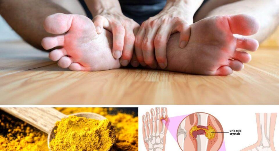 If You Have Gout, Try Turmeric for Powerful Inflammation & Pain Relief! TheWellthieone