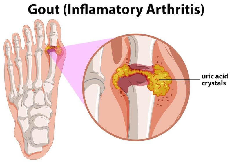 Too much uric acid in the blood can lead to painful gout outbreaks as the uric acid gathers around the joints, especially the big toe.
