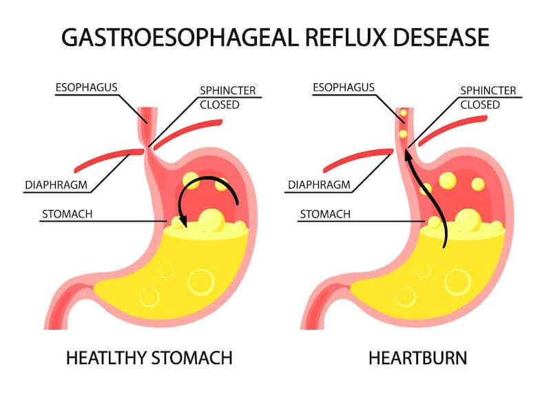Esophageal cancer is a risk for someone who has had acid reflux and heartburn for an extended period of time. 