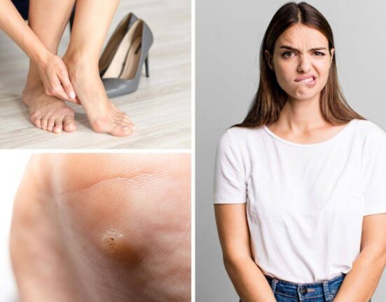 Are Plantar Warts Contagious? Plantar Warts 101, What You Need To Know! Thewellthieone