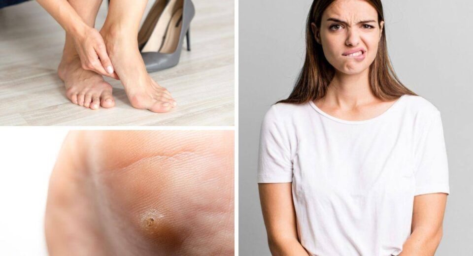 Are Plantar Warts Contagious? Plantar Warts 101, What You Need To Know! Thewellthieone