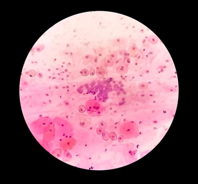 Cells with Human Papillomavirus Virus amongst them under a microscope.