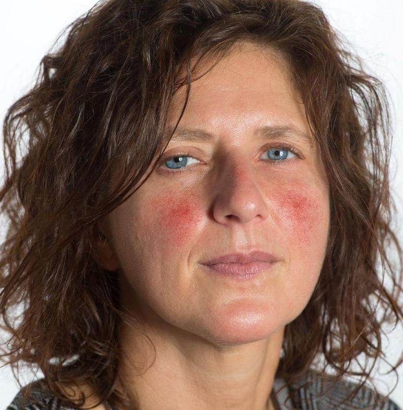 Rosacea is often characterized by red, inflamed patches on the skin, often in the midface, cheek area.