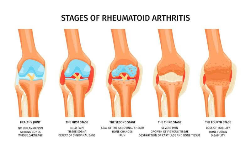 Rheumatoid arthritis is where the body’s immune system attacks its own joint tissues, wearing them away.
