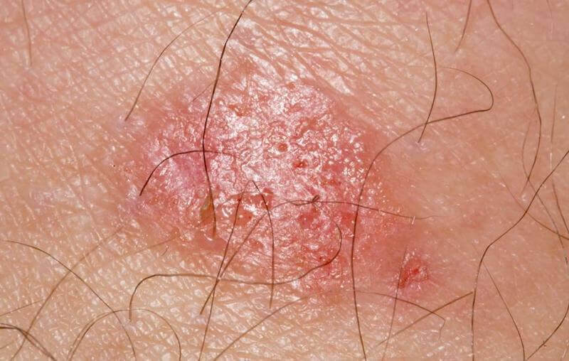 Ringworm is a fungus, it is not bacteria.
