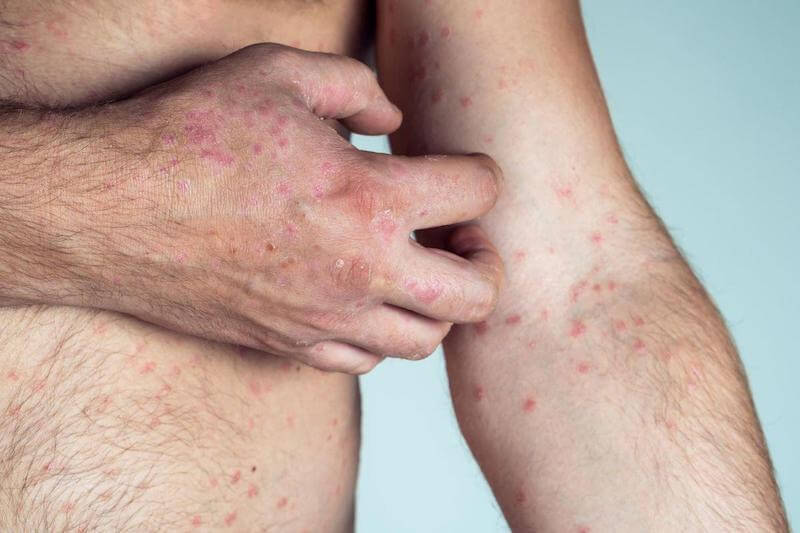 It is common to get rashes and sensitive skin from EMF exposure. 