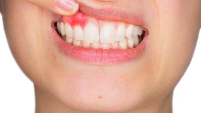 Create Your Own Homemade Clove Toothpaste for a Total Oral Health ...
